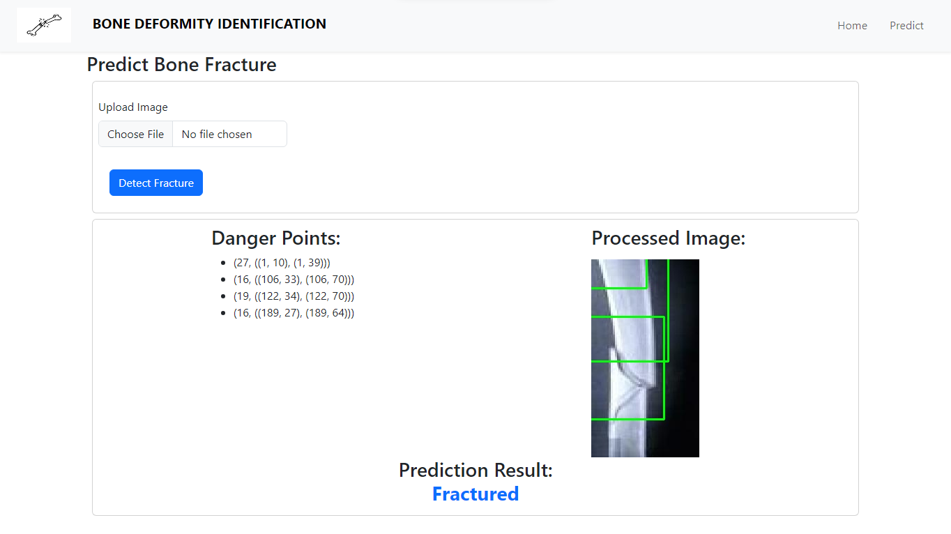 Bone Fracture Detection